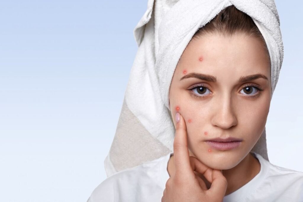 acne treatments in Menifee